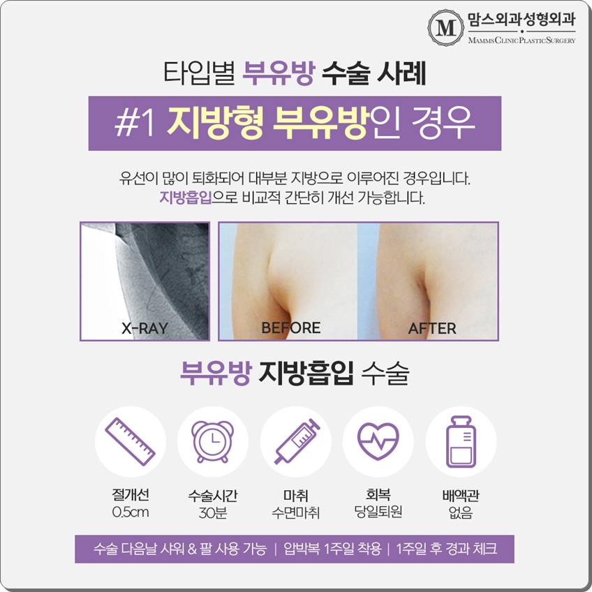 부유방제거수술 내게 맞는 것으로 관련 이미지 6