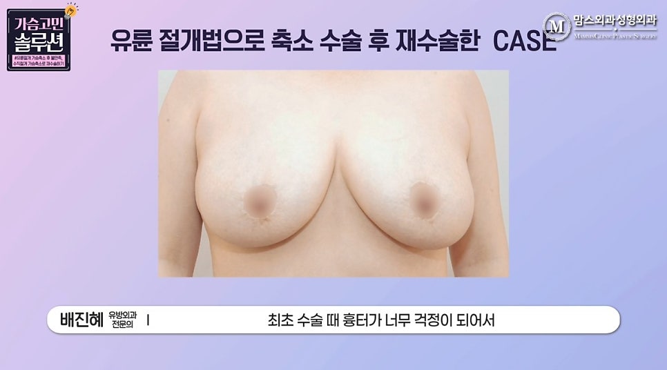 유륜절개 가슴축소 수술 후 수직절개 재수술, 가능할까? 관련 이미지 3