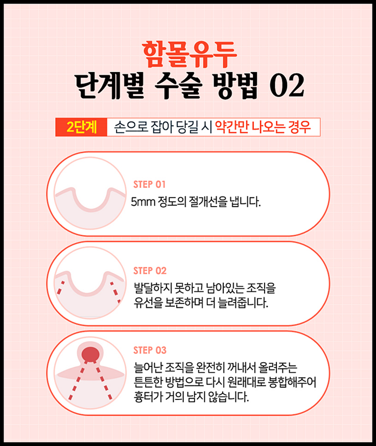 함몰유두수술비용 올바른 선택을 위해서는? 관련 이미지 6