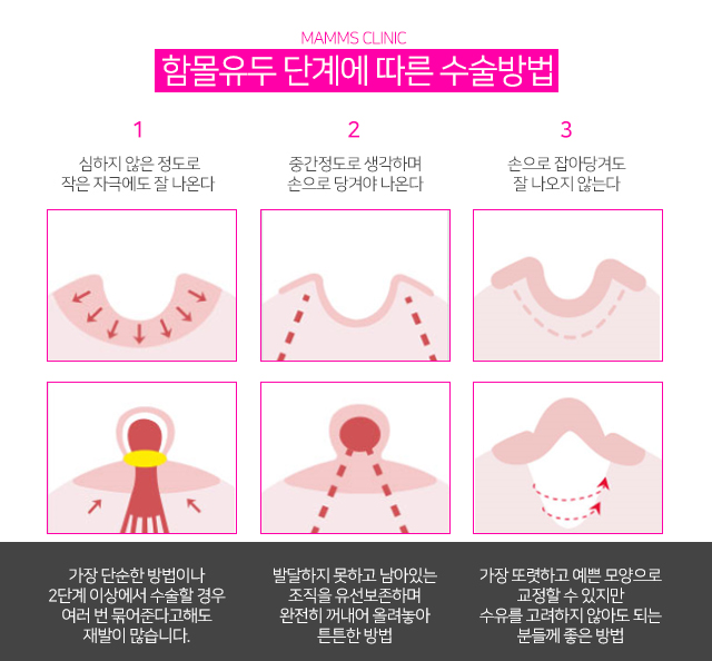 함몰유두전후 달라진내모습 관련 이미지 5
