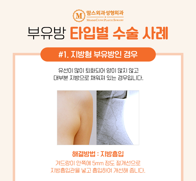 겨드랑이볼록 부유방 덜어내고 편안한 일상으로! 관련 이미지 4