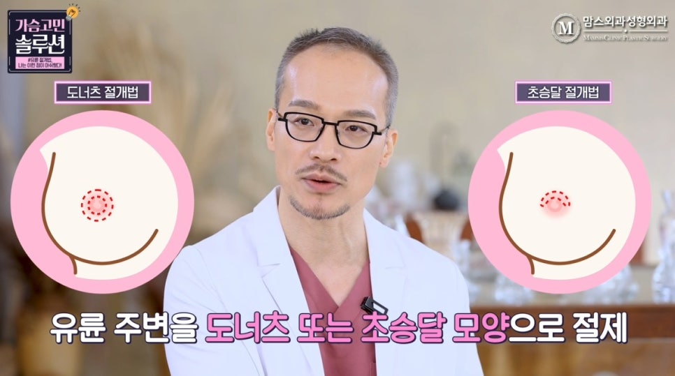 Breast Reduction with Areolar Incision: What Was the Drawback? image 8