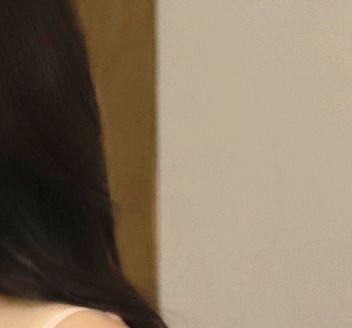 겨드랑이몽우리 라인부터 재발까지 생각하는 솔루션! 관련 이미지 16