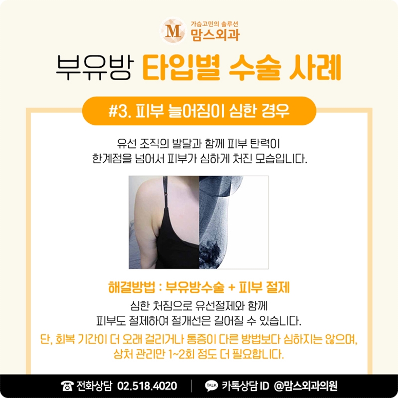가슴 멍울 도대체 어떤 것일까? 관련 이미지 7
