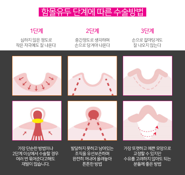 함몰유두분비물 그냥넘기지마세요 관련 이미지 3