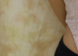 겨드랑이살 볼륨 줄이고 슬림한 라인을 원한다면? 관련 이미지 22