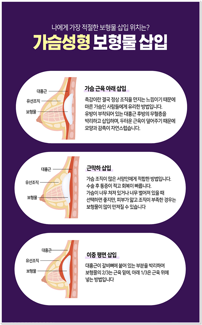 벨라젤가슴성형 부러워하지! 관련 이미지 9