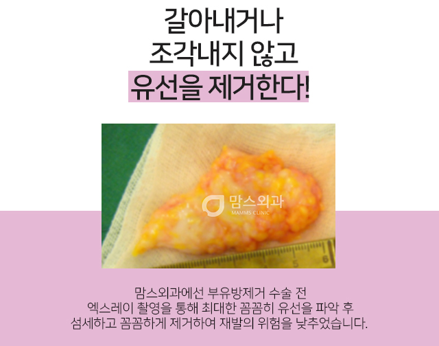 모유수유겨드랑이멍울 갑자기생겼다 관련 이미지 3