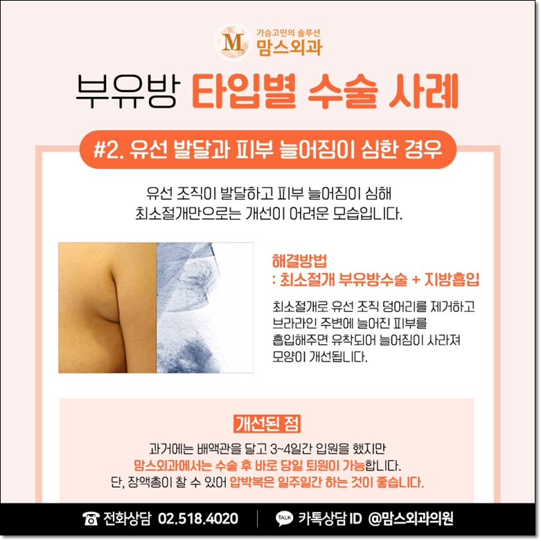 겨드랑이지방흡입 고려한다면 관련 이미지 6