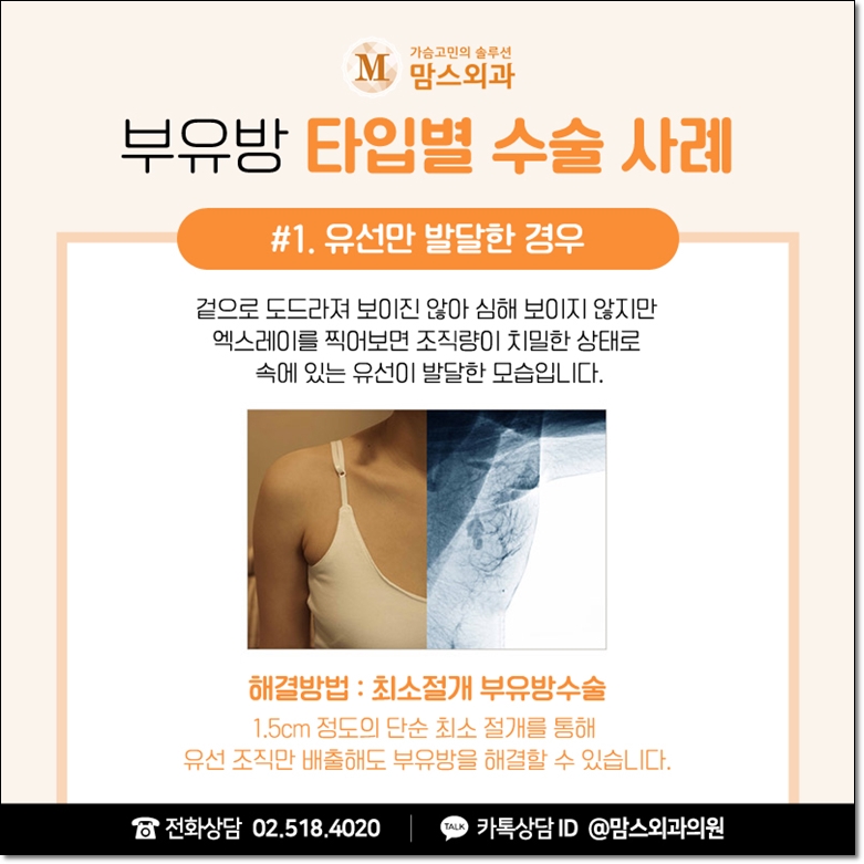 겨드랑이지방흡입 고려한다면 관련 이미지 5
