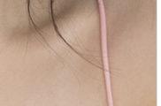 겨드랑이 몽우리 걱정스럽나요? 관련 이미지 21