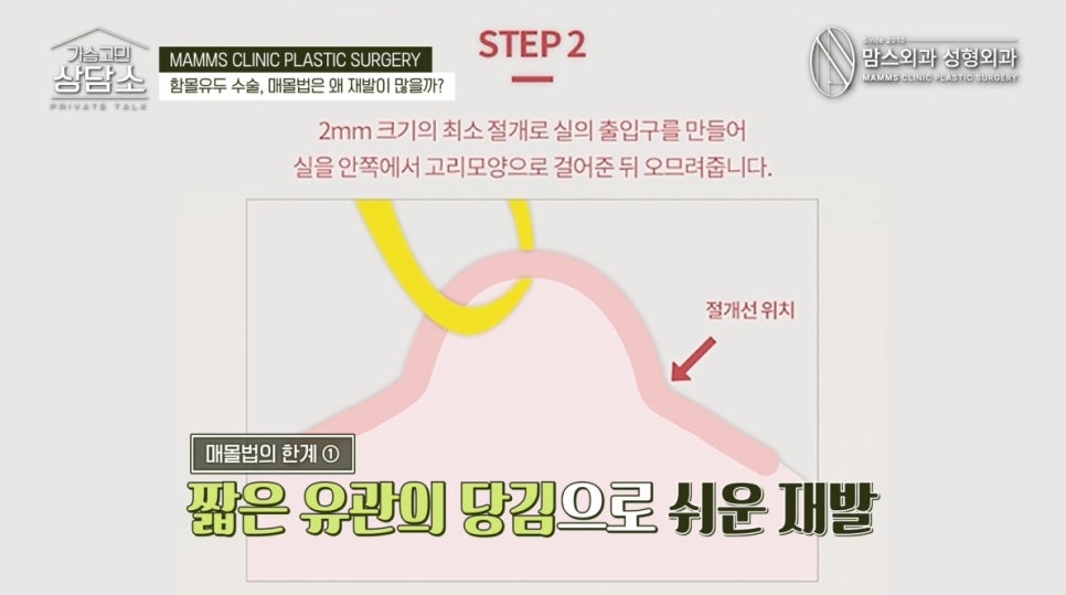 모유수유냐, 모양이냐! 나에게 맞는 함몰유두 수술법은? 관련 이미지 4