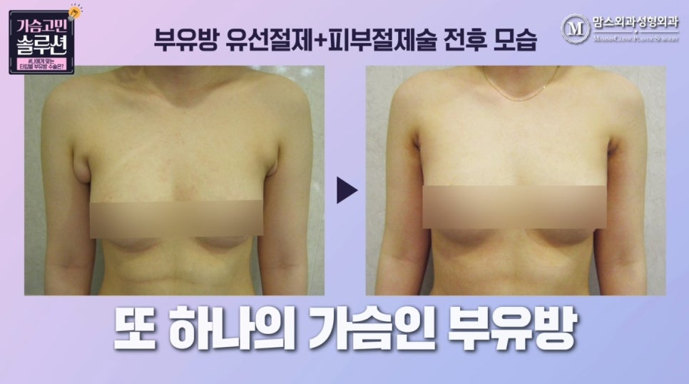 부유방제거수술 유형별 수술 방법은? 관련 이미지 11