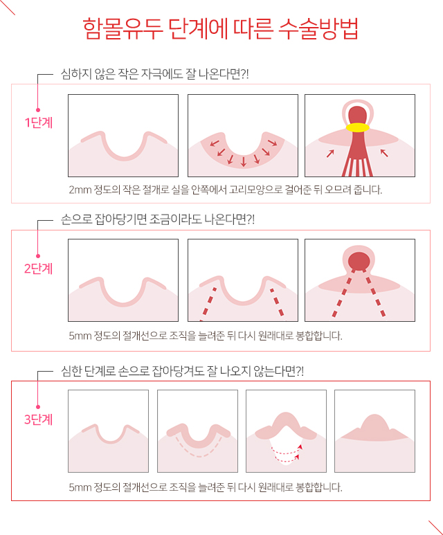 함몰유두유방암 연관있을까 관련 이미지 3