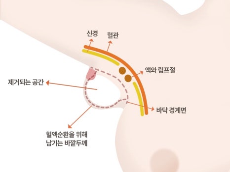 겨드랑이멍울병원 부유방, 유선만 제거하면 끝일까요? 관련 이미지 21