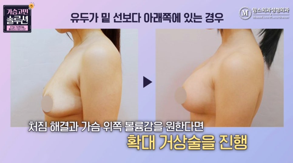 가슴 거상확대술, 줄이면서 키운다고요? 관련 이미지 9