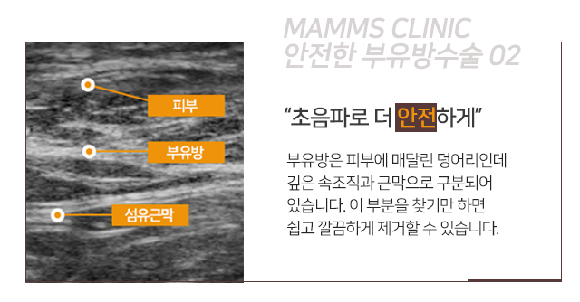 부유방주사 보다근본적으로 관련 이미지 5