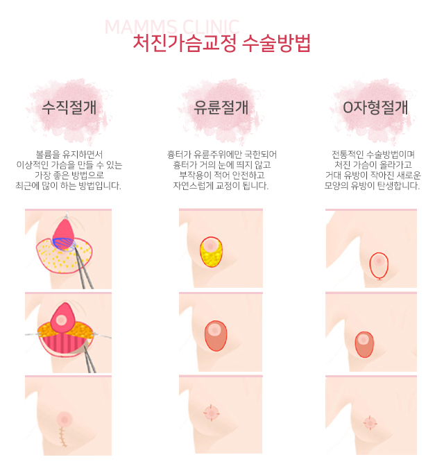 처진가슴수술후기 비교해보세요 관련 이미지 3