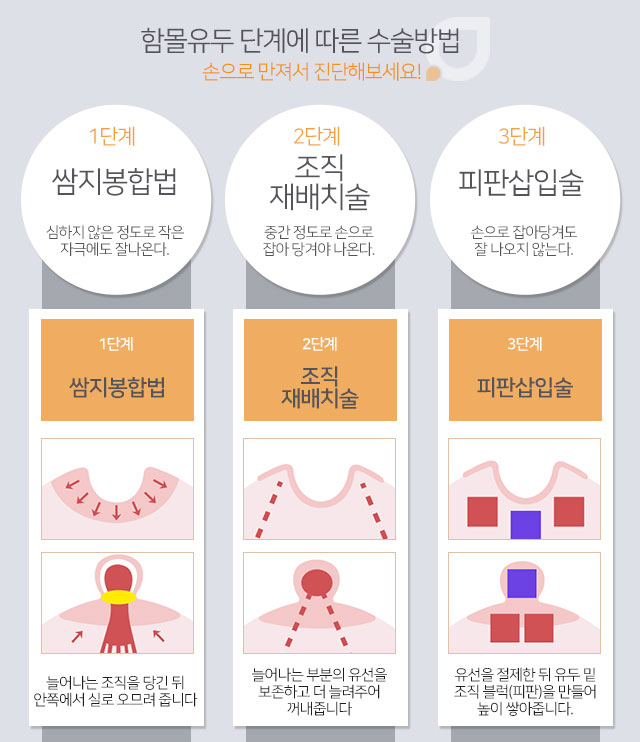 함몰유두수술비용 합리적인선택 관련 이미지 3