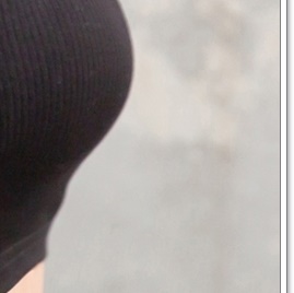 Breast Sagging Surgery to Regain Firmness image 20