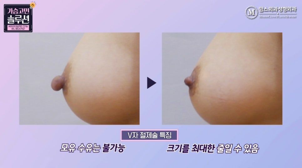 유두축소술이 필요한 유두 사이즈는? 관련 이미지 7