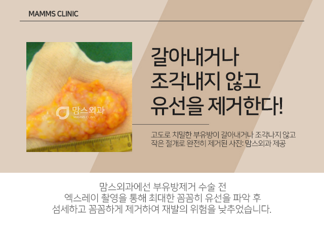 암산부부유방 늦기전에 관련 이미지 4