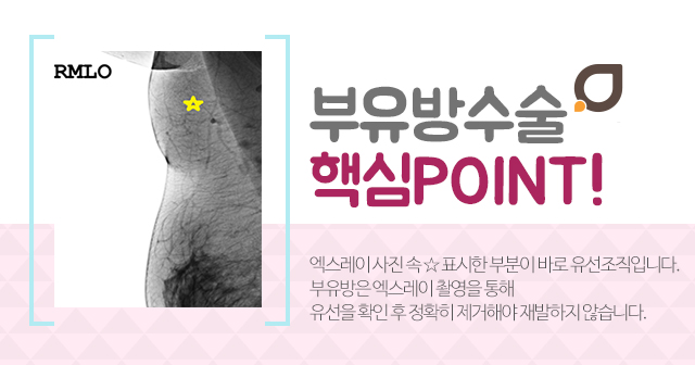 부유방수술비용 크기에상관없어요 관련 이미지 3