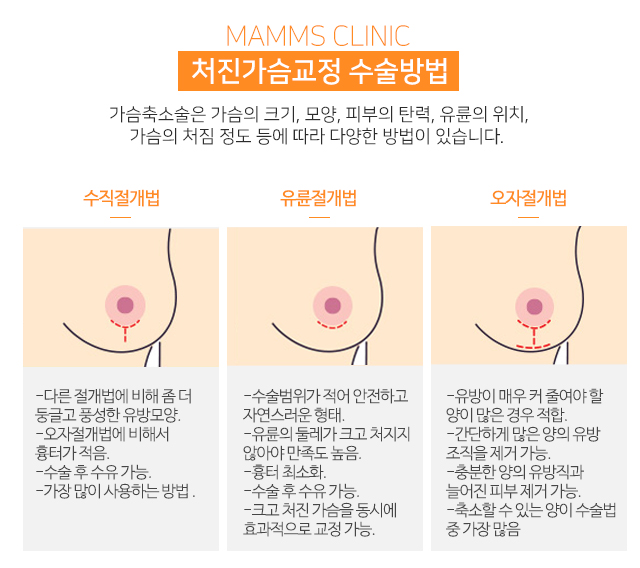 처진가슴교정수술 체형을고려해서 관련 이미지 3