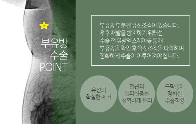 부유방지방흡입 유선제거를 확인하세요 관련 이미지 3