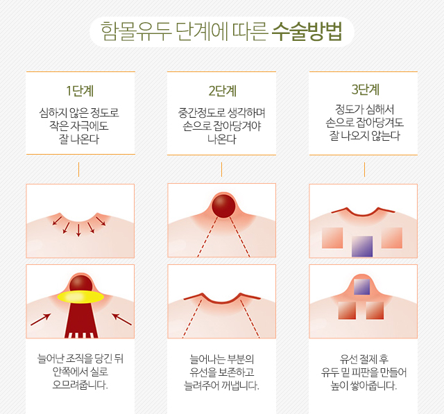 강남함몰유두수술 단계에맞게 관련 이미지 4