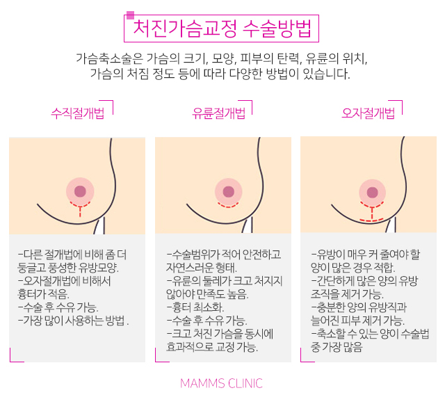 가슴처짐증 말못할고민 관련 이미지 3