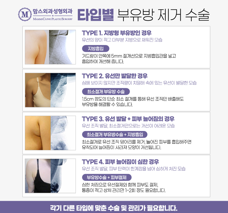 겨드랑이살빼기 맞춤형 솔루션 받아보세요. 관련 이미지 4
