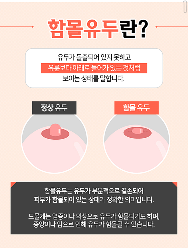 함몰유두수술후기 어떻게 변할까 관련 이미지 2