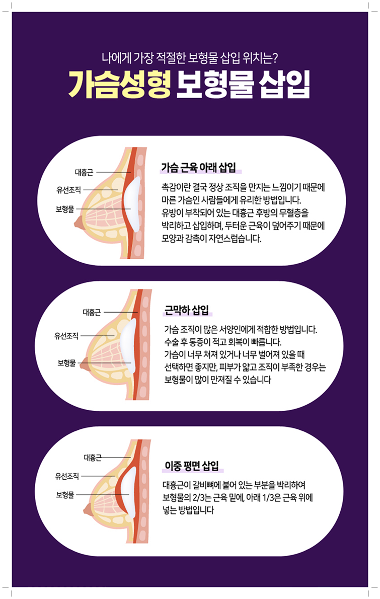 가슴확대수술가격 꼼꼼하게 알아봤죠 관련 이미지 9