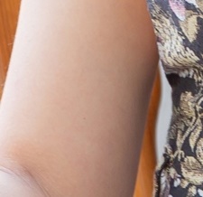 부유방제거수술 생각을 다지고 관련 이미지 26