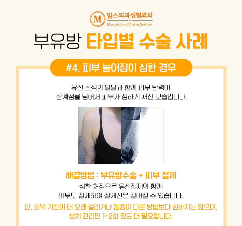 겨드랑이부유방 유형에 맞춘 다양한 솔루션 경험해보세요! 관련 이미지 4