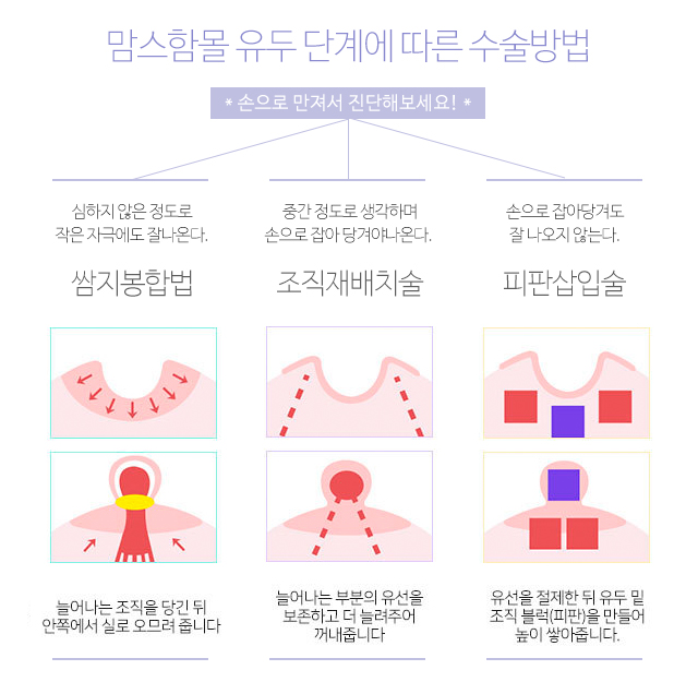 함몰유두수술 나에게맞게 관련 이미지 3
