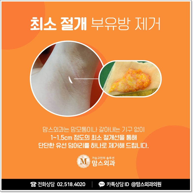 겨드랑이지방흡입 먹히지 않는다면 관련 이미지 6