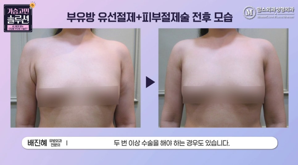 부유방제거수술 유형별 수술 방법은? 관련 이미지 14
