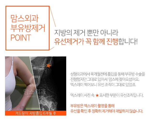 부유방제거병원 한번에꼼꼼하게 관련 이미지 3