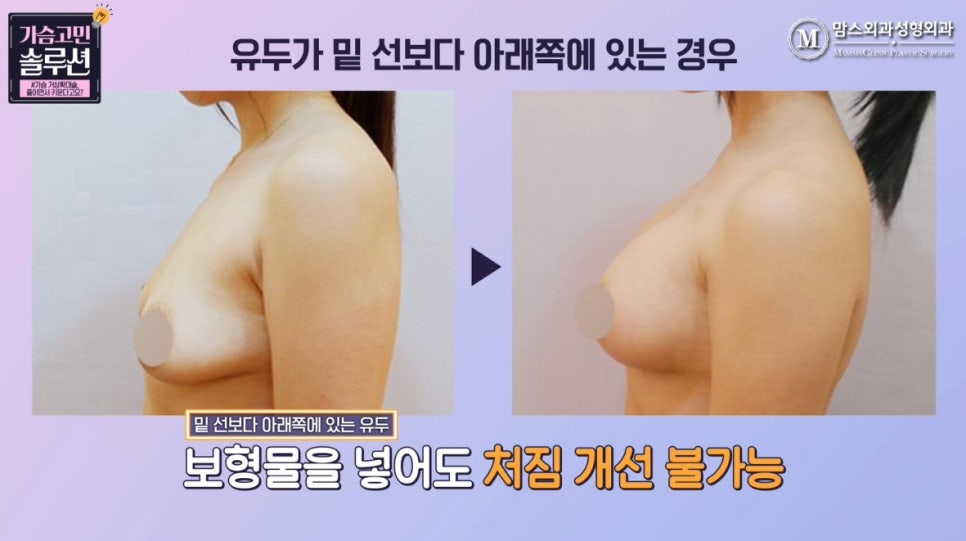 가슴 거상확대술, 줄이면서 키운다고요? 관련 이미지 8