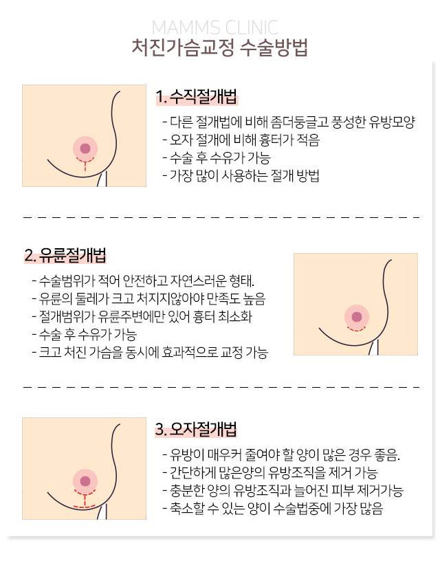 처진가슴교정 안전까지생각 관련 이미지 3