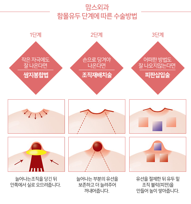 함몰유두염증 고민은 관련 이미지 3