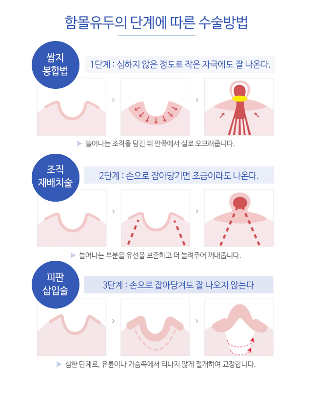 함몰유두수술비용 알려드릴게요 관련 이미지 3