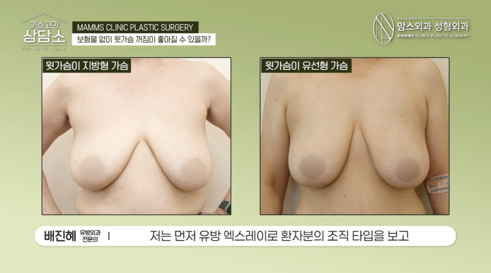 보형물 없이 윗가슴 꺼짐 해결될까? 가슴축소·거상 수술 전 필수 체크! 관련 이미지 6