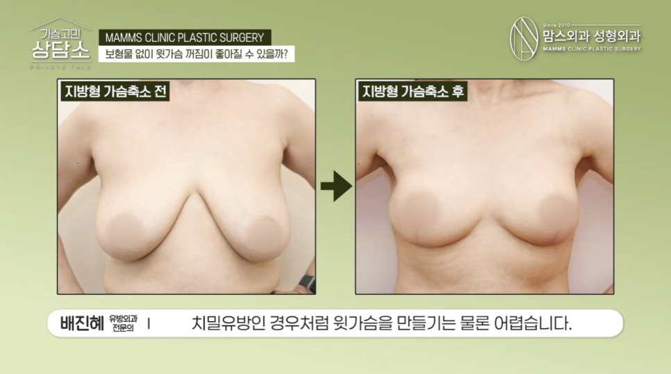 보형물 없이 윗가슴 꺼짐 해결될까? 가슴축소·거상 수술 전 필수 체크! 관련 이미지 7