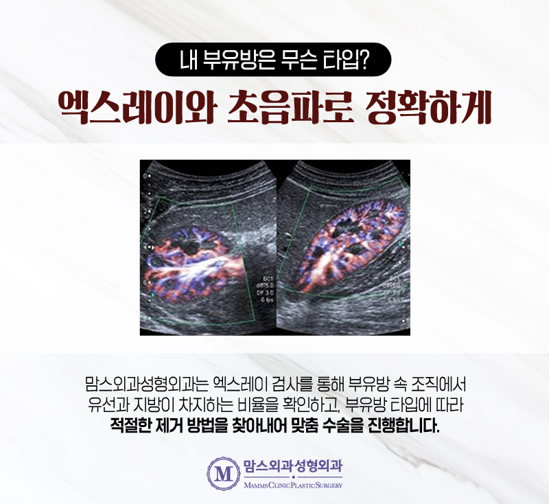 겨드랑이부유방 유형에 따라 다른 치료 방법이 중요한 이유! 관련 이미지 6