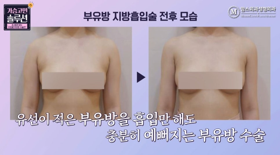 부유방제거수술 유형별 수술 방법은? 관련 이미지 8