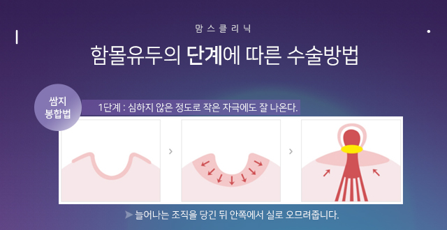 유두함몰 걱정없이 관련 이미지 5