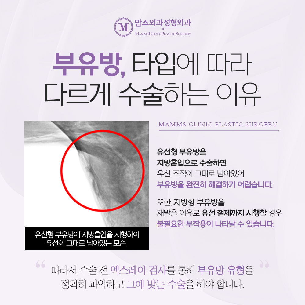 겨드랑이부유방제거 원인에 따라 수술 방법도 다르게 해야 하는 이유! 관련 이미지 4